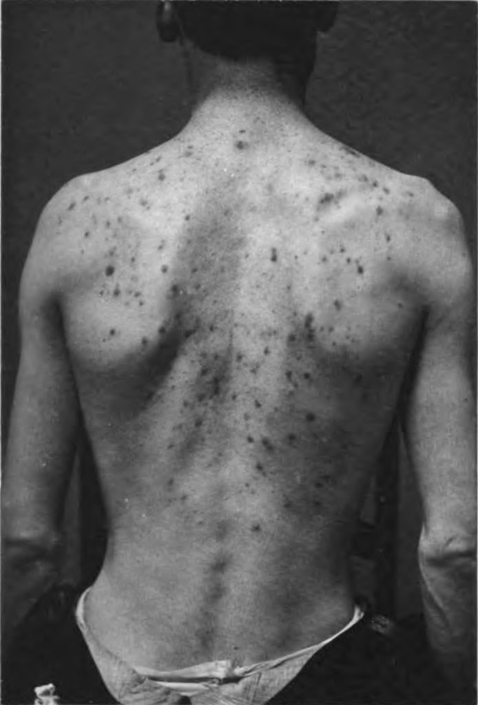 Acne Scars
