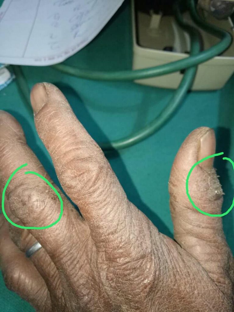 Eczema Consultation