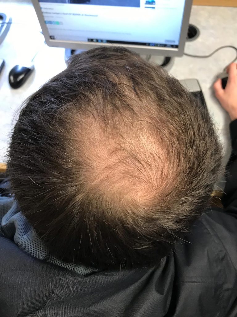 Hair Loss Consultation