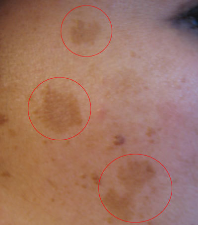Pigmentation Consultation