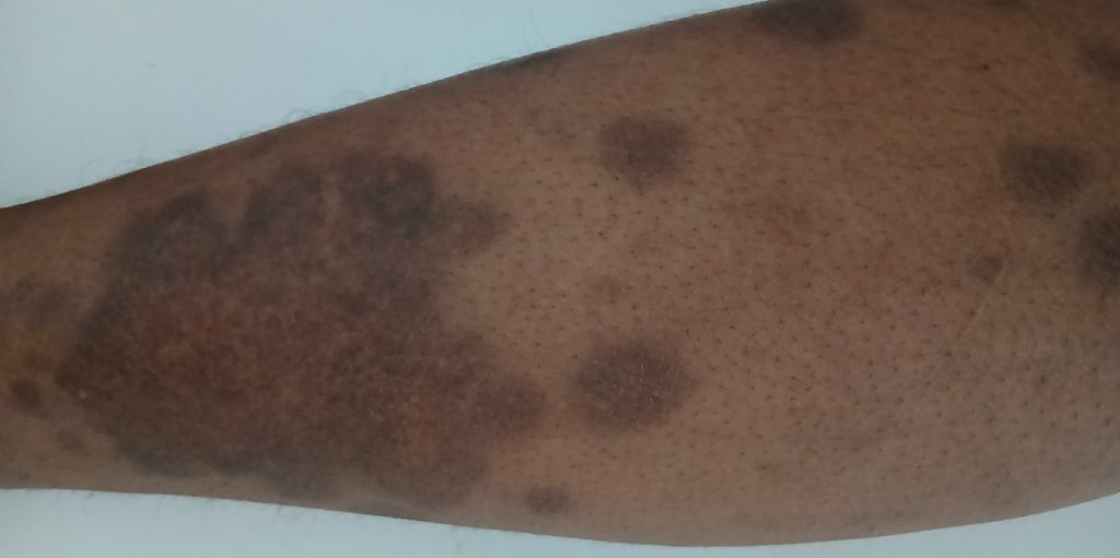 Psoriasis