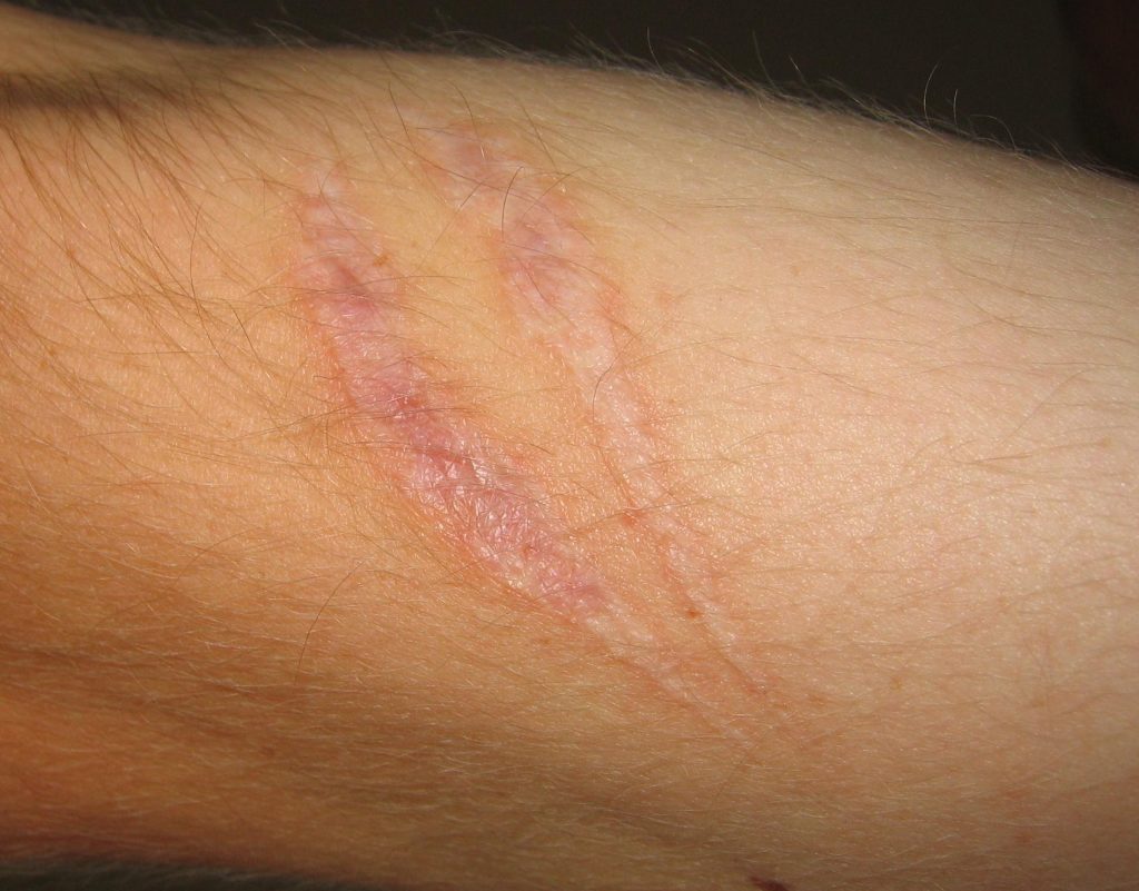 Scar Treatment