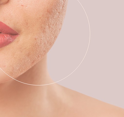 acne before