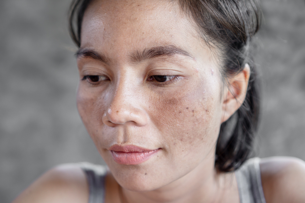 melasma before